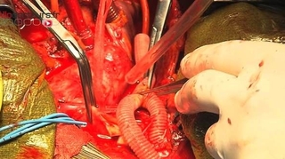 Dissection aortique : une urgence cardiaque