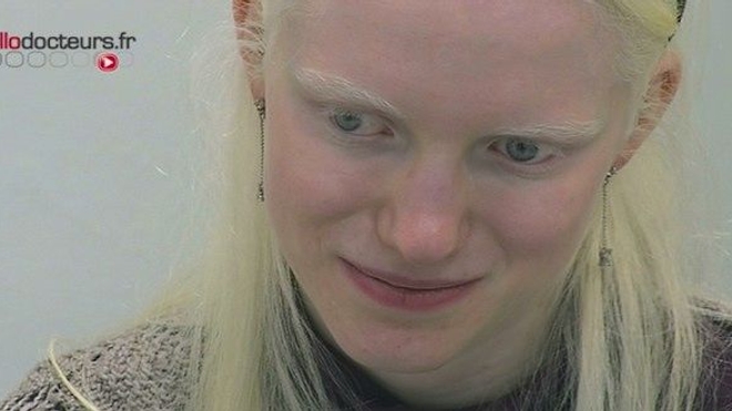 Albinisme : juste une question de couleur