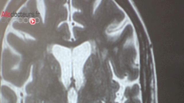 La migraine pourrait altérer les structures du cerveau à long terme