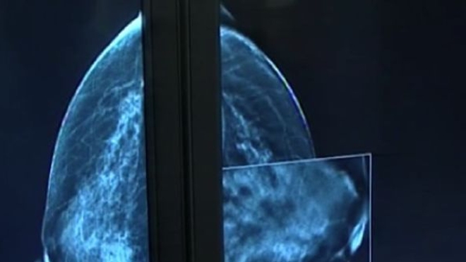 Dépistage du cancer du sein : après 70 ans, beaucoup de faux-positifs