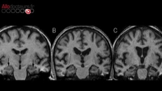 Alzheimer : diagnostiquer et annoncer la maladie