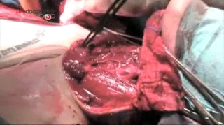 Première implantation d'un larynx artificiel chez l'homme