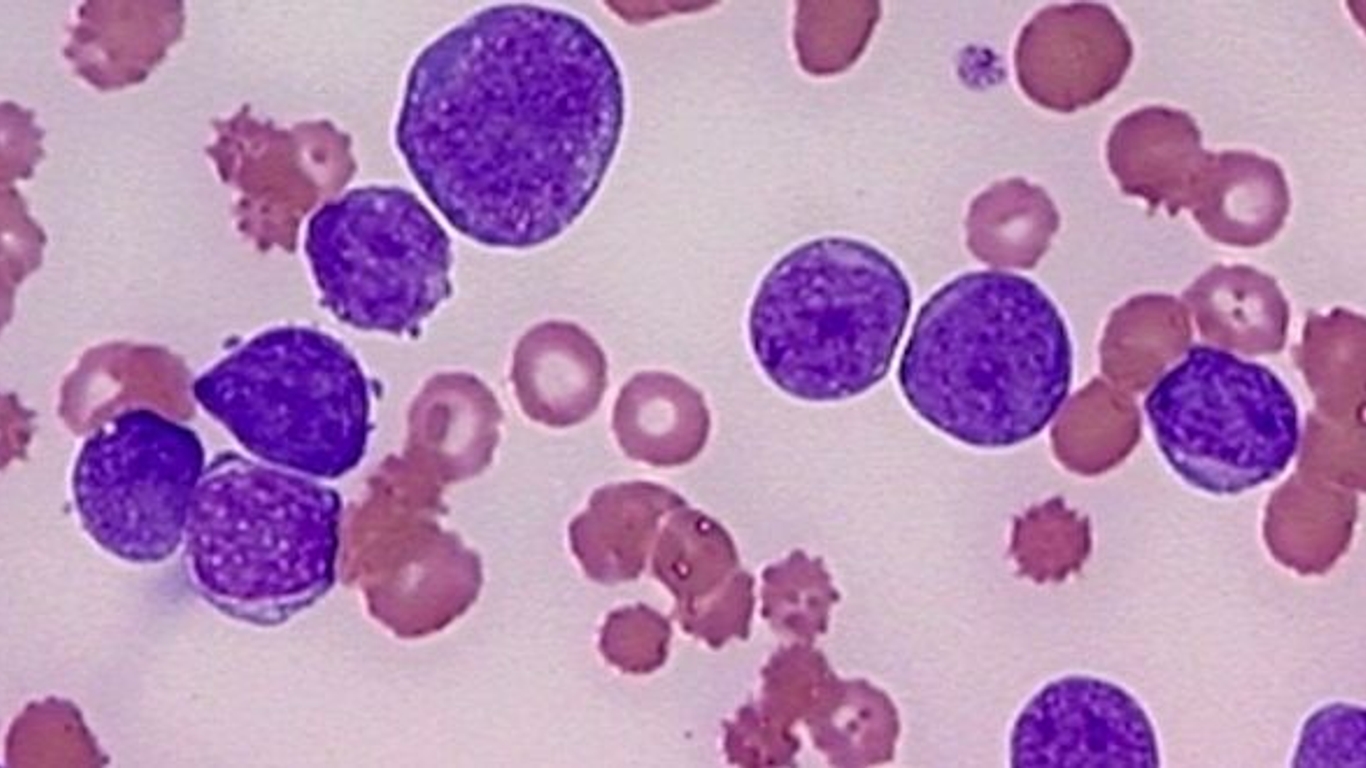 Infiltrat Inflammatoire Lymphocytaire Et Plasmocytaire Les cas de leucémies et lymphomes ont plus que doublé en 30 ans