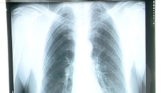 Cancer du poumon : le dépistage organisé permettrait de réduire la mortalité d’au moins 25%
