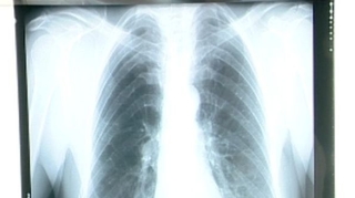 Cancer du poumon : le dépistage organisé permettrait de réduire la mortalité d’au moins 25%