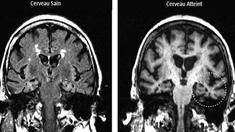 Découverte de onze nouveaux gènes favorisant Alzheimer