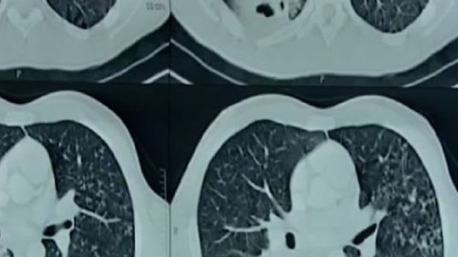 radiologie d'un poumon infecté de la tuberculose