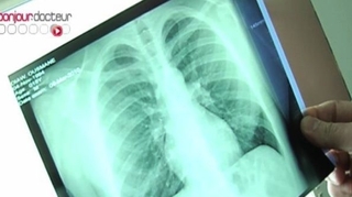 Un cas de tuberculose signalé dans un lycée de Meurthe et Moselle