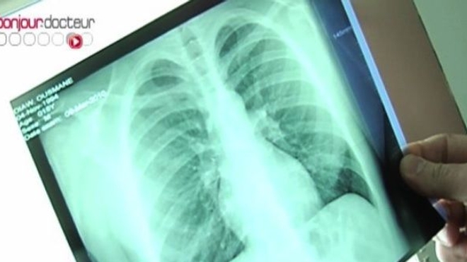 Un cas de tuberculose signalé dans un lycée de Meurthe et Moselle