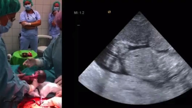 A gauche, la mise au monde de l'enfant par césarienne. A droite, l'une des échographies réalisées avant l'accouchement. (source : clinique de Debrecen)