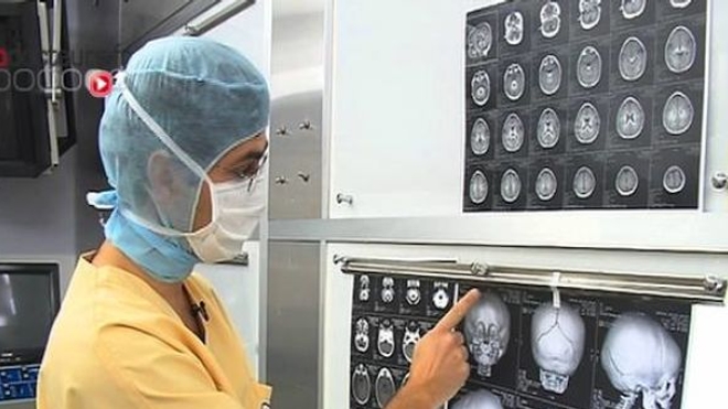 Craniosténose : opérer pour libérer le cerveau du bébé