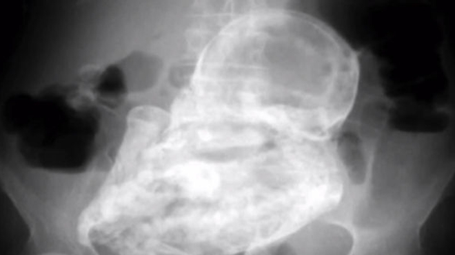 Radiographie du lithopédion de la colombienne de 82 ans diagnostiquée le 9 décembre (crédit photographique : Tunjuelito Hospital, Bogota, Colombie)