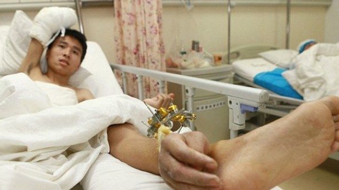 Un jeune Chinois dont la main a été raccordée à sa cheville le temps de réparer son avant-bras © HAP/ Quirky China News/ REX