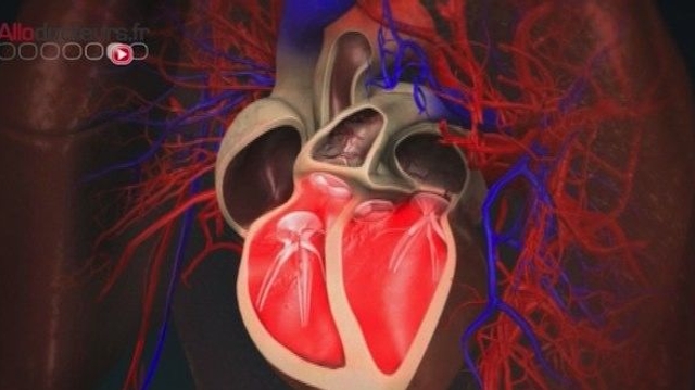 L'insuffisance cardiaque : une maladie irréversible