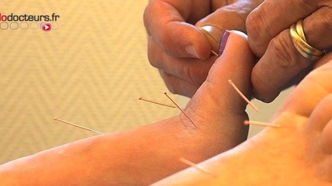 Acupuncture : comment est-elle pratiquée ?