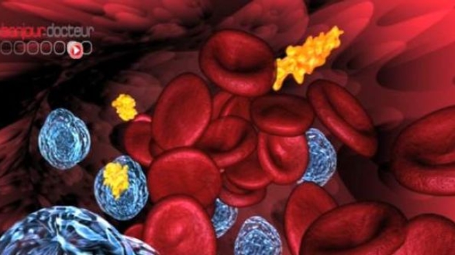 Leucémie : résultats encourageants de l'immunothérapie