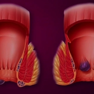 Hémorroïdes : les veines anales en crise