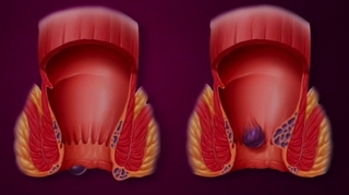 Hémorroïdes : les veines anales en crise