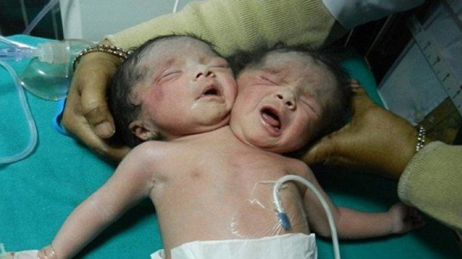 Inde : un bébé est né avec deux têtes