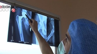 Prothèse de hanche : opérer et rééduquer