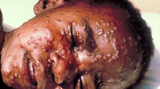 Faut-il détruire le virus de la variole ?