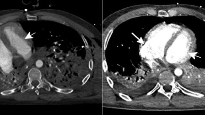 Scanner du coeur  avant (1) et après (2) l'intervention (vue du dessous). La plus petite flèche désigne le ventricule droit, la plus large le ventricule gauche. Crédit : NEJM