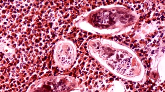 Oeufs de Schistosoma haematobium (ver responsable de la bilharziose uro-génitale) dans une vessie. (Crédit photo : CDC/ Dr. Edwin P. Ewing, Jr)