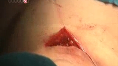 Nano-colle : la fin des points de suture ?