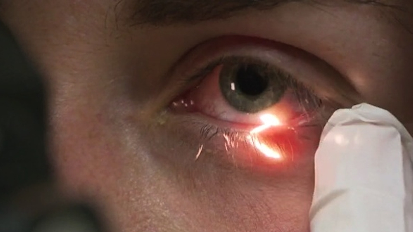 conjonctivite keratite uveite attention les yeux allodocteurs
