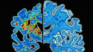 Maladie d'Alzheimer : un test génétique prédit l'âge des premiers symptômes