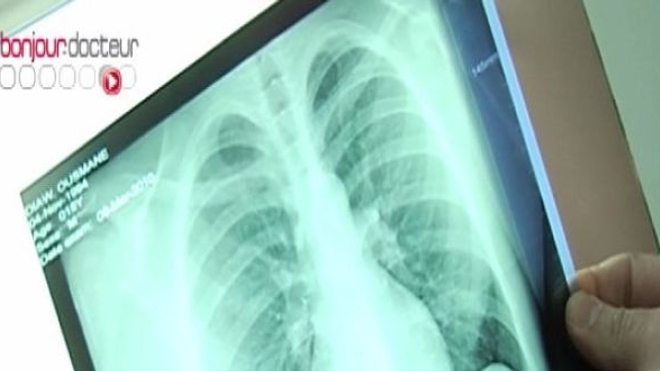 Les maladies respiratoires, facteurs de risque du cancer du poumon ...