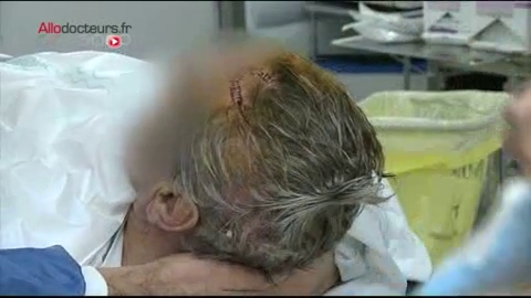 Implantation d'un dispositif de stimulation électrique à fréquence élevée. Attention images de chirurgie impressionnantes ! Chirurgie de stimulation cérébrale