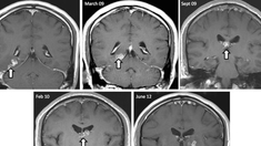 Un ver cheminait dans son cerveau