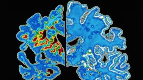 Peut-on diagnostiquer à tort la maladie d'Alzheimer ?