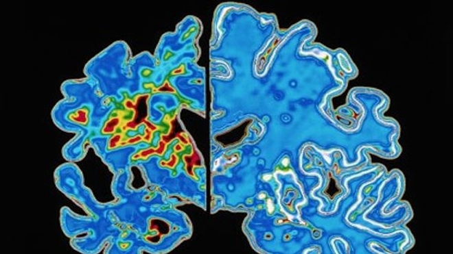 Peut-on diagnostiquer à tort la maladie d'Alzheimer ?