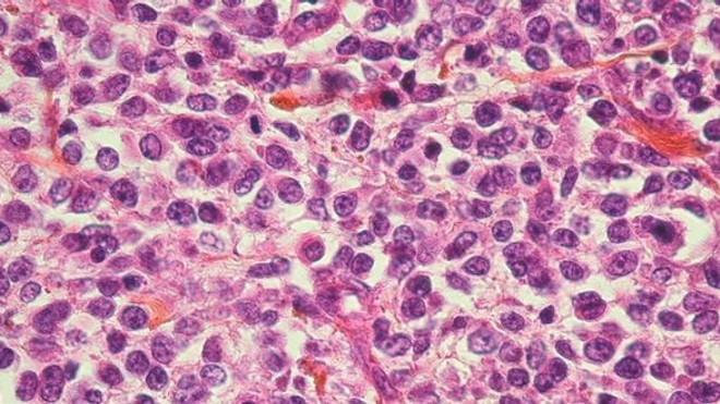 Les métastases forment un ensemble de cellules tumorales, issues d'un cancer primitif (Image d'illustration)