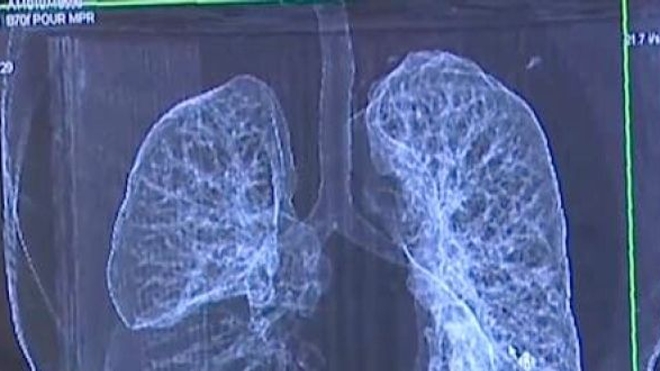 Le cancer du poumon plus meurtrier que le cancer du sein chez les Européennes en 2016