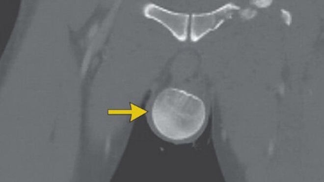 Scanner du bassin du patient. La flèche jaune pointe la tête du fémur, la flêche bleue les zones de la hanche fracturées lors de l'accident. (source : doi:10.1056/NEJMicm1313857)