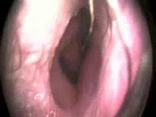 Attention, ces images médicales peuvent être choquantes. Vidéo : Examen endoscopique du patient brésilien (source - NEJM / crédits - A.F.B. Marco & M.D Baptista) - Illustration : une larve de Lucilie bouchère (cliché : John Kucharski, USDA, 2006)