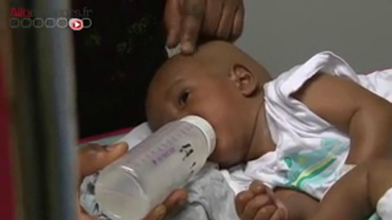 Des Bebes Siamois Separes A L Hopital Necker Allodocteurs
