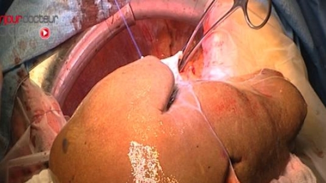 90% des personnes atteintes de cancer du foie souffraient au préalable de cirrhose (Image d'illustration)