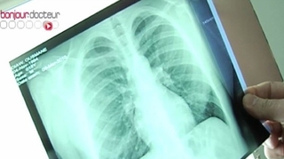 Quatre des cinq cas de tuberculose chez des CRS de Limoges démentis