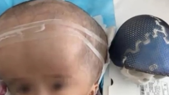 L'opération pour donner à la petite fille un nouveau crâne a duré 17 heures. Capture d'écran Youtube. 
