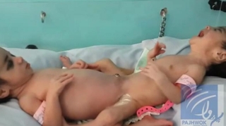 Des bébés siamois séparés avec succès à Kaboul