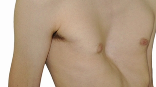 Pectus excavatum : la poitrine creuse