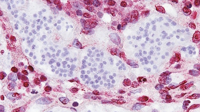 Cellules cancéreuses originaires du ténia au milieu de cellules humaines, après coloration en laboratoire pour analyse (source : NEJM, doi: 10.1056/NEJMoa1505892)