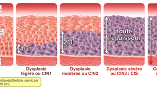 Quels sont les différents stades des lésions dues à des HPV ? (Image ©Papillomavirus.fr)