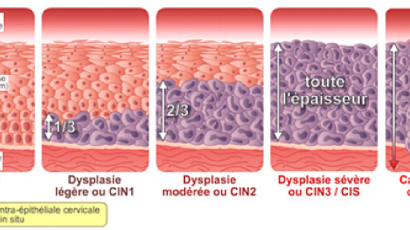 papillomavirus stade 3 conisation