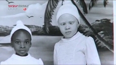 Albinisme : la peau en souffrance
