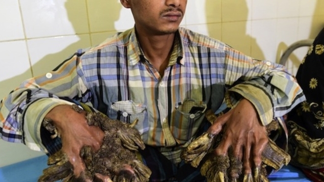 Abul Bajandar, "l'homme-arbre", sera bientôt libéré de ses verrues géantes - ©Munir Uz Zaman - AFP